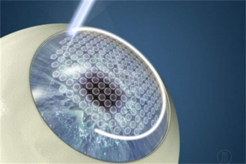 半飛秒激光手術過程