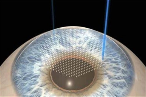 全飛秒激光手術(shù)