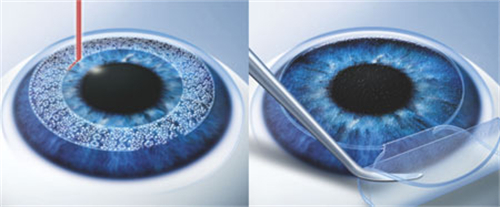 全飛秒手術(shù)圖示