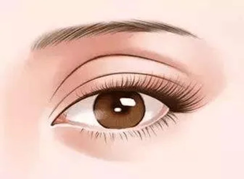 雙眼皮修復(fù)卡通示意圖