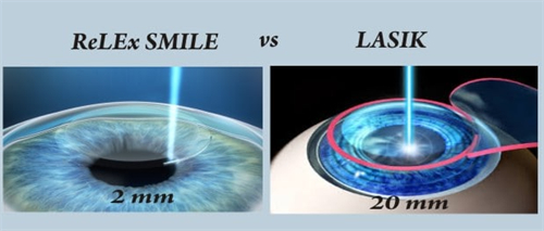 全飛秒近視手術帶來的切口圖解