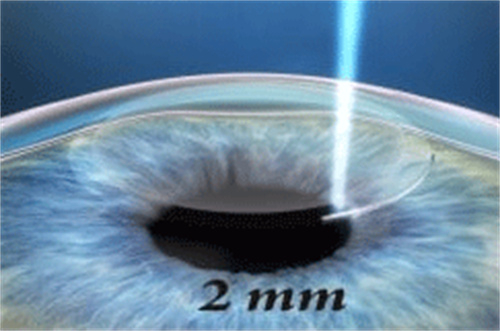 全飛秒手術(shù)