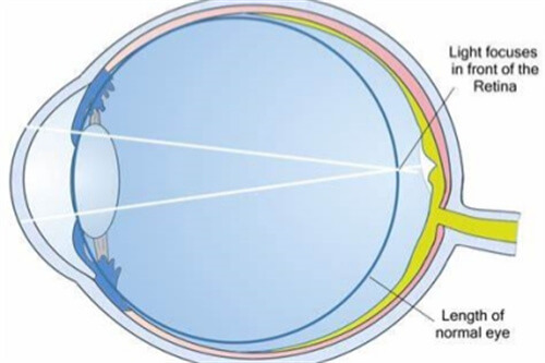 屈光不正近視示意圖