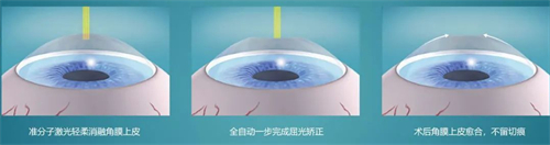 近視手術簡要流程