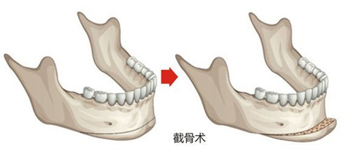 vline手術前后變化