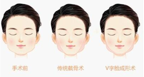 下巴寬大手術后<span style=