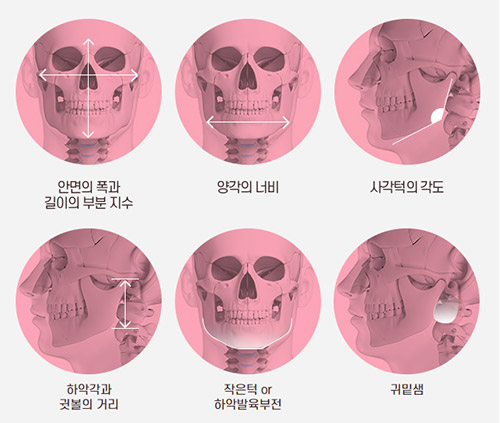 面部輪廓手術示意圖