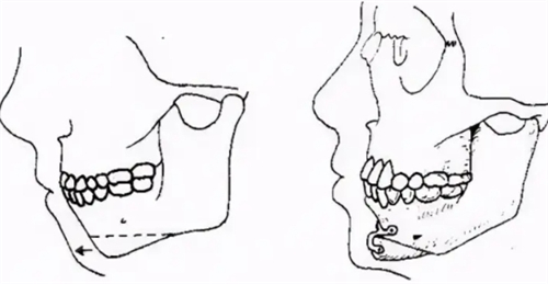 頦成形術(shù)手術(shù)過程