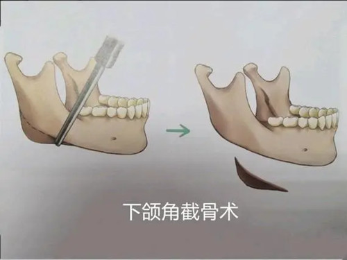 下頜角截骨術(shù)卡通示意圖