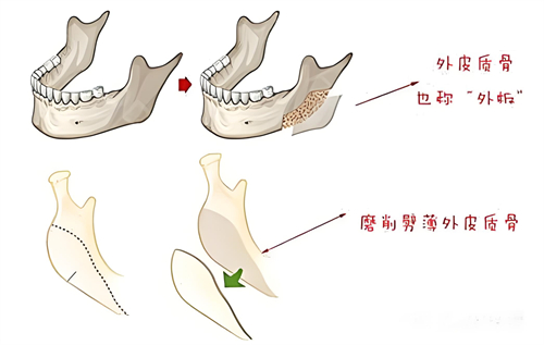 下頜骨切除術(shù)過程演示動(dòng)畫圖