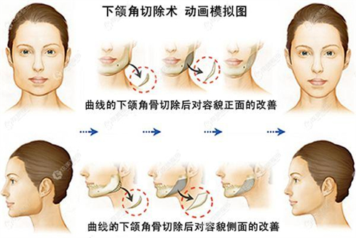 下頜角切除術(shù)動(dòng)畫模擬圖