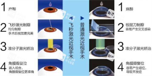 飛秒近視手術(shù)與激光近視手術(shù)的過程區(qū)別圖解
