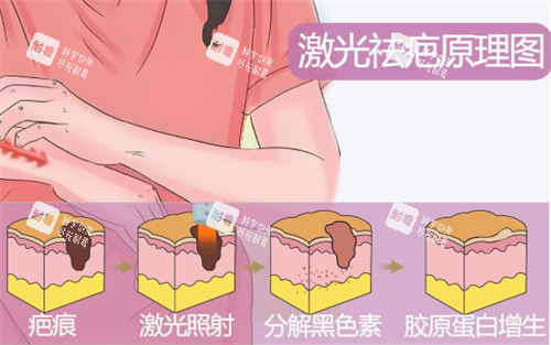 激光祛疤原理示圖