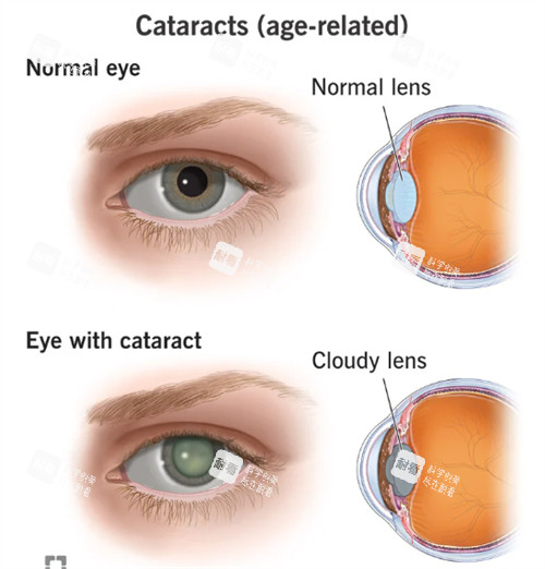 正常眼睛和白內(nèi)障眼睛