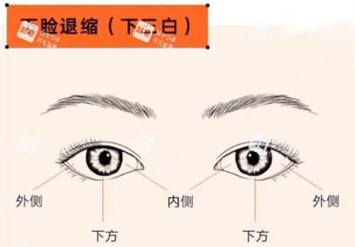 眼修復(fù)下瞼退縮
