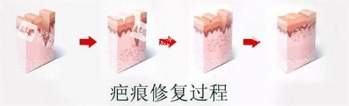 疤痕修復(fù)過(guò)程圖