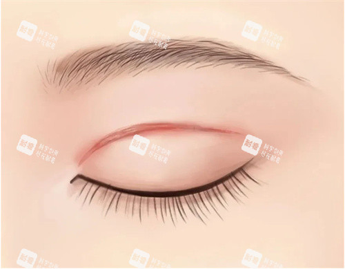 雙眼皮肉條疤痕圖