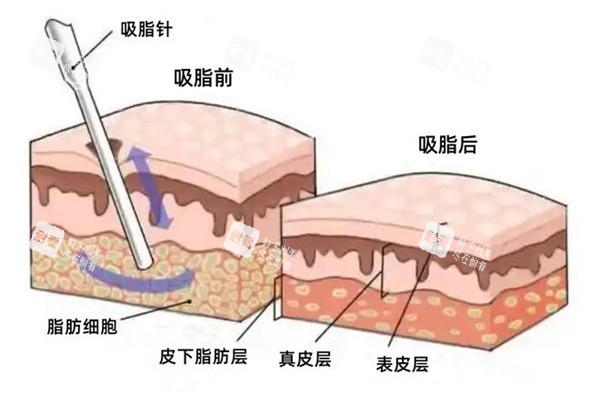 面部吸脂圖