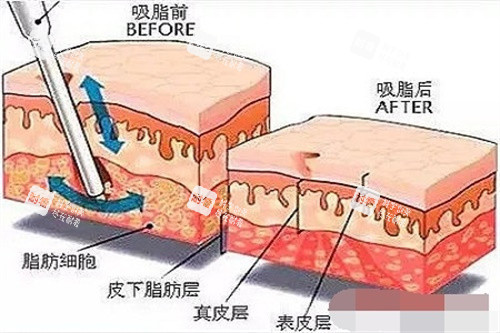 吸脂前后脂肪對(duì)比圖