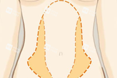 腰腹吸脂位置示意圖