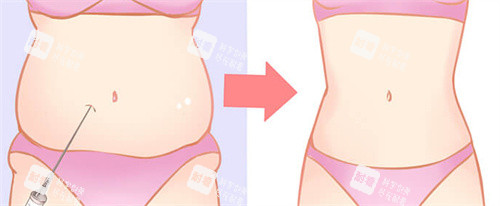肚子吸脂前后對比