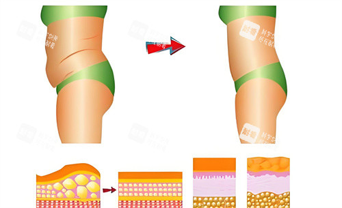 腰腹部吸脂術(shù)前后對比動畫圖
