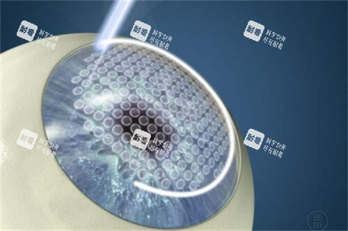 半飛秒激光手術(shù)過程