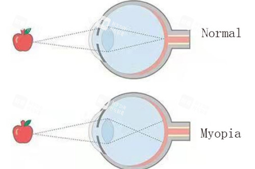 近視眼與正常眼對(duì)比