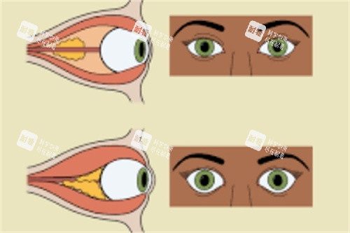 近視眼球對比圖