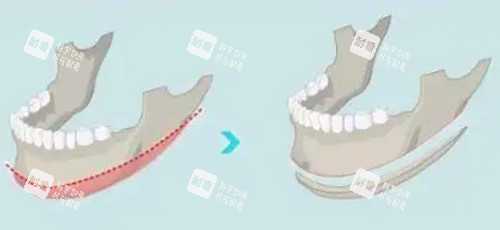 下頜角長(zhǎng)曲線截骨前后對(duì)比