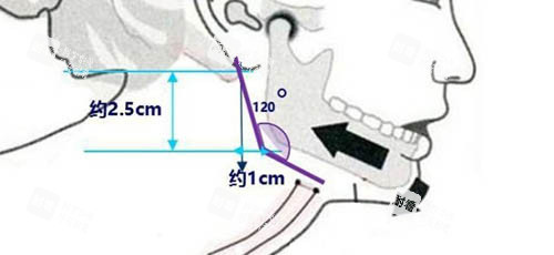下頜角手術(shù)角度設(shè)計(jì)圖