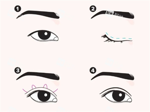 埋線雙眼皮手術(shù)過程圖