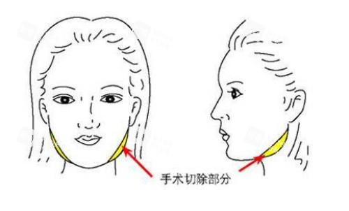 面部磨骨手術(shù)示意圖