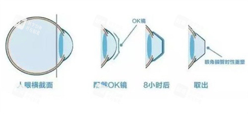 佩戴OK鏡的原理