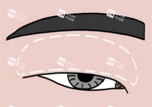 腫眼泡做雙眼皮對(duì)比示意圖