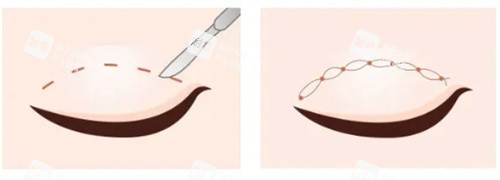 雙眼皮切開(kāi)vs雙眼皮埋線