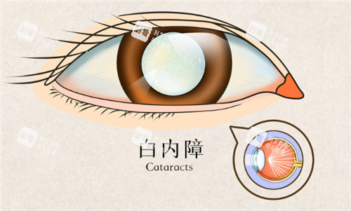 白內(nèi)障眼睛表現(xiàn)