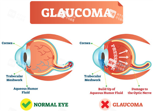 正常眼睛和青光眼的對比