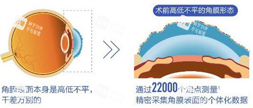 個(gè)性化飛秒術(shù)前