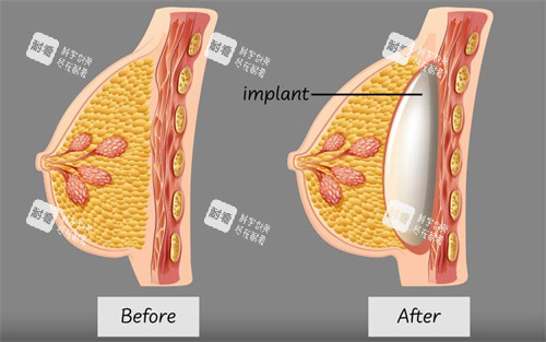 假體隆胸植入的層次