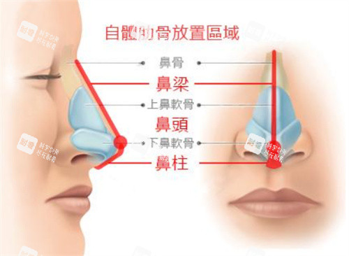 鼻部整形示意圖