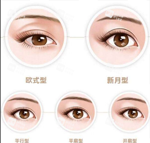 雙眼皮類型圖示