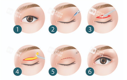雙眼皮全切手術(shù)過(guò)程