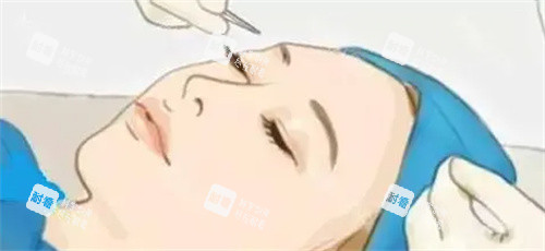 雙眼皮手術(shù)過(guò)程卡通圖