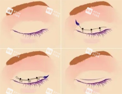 雙眼皮手術(shù)示意圖