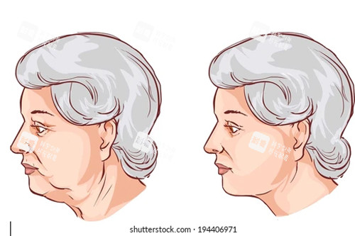 頸部拉皮卡通圖 頸部拉皮卡通圖