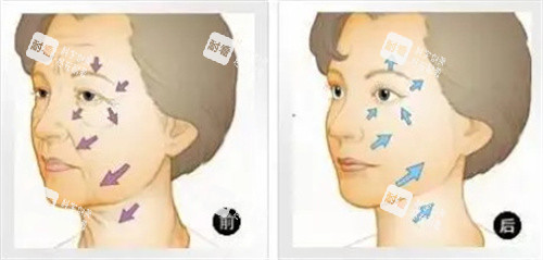 面部抗衰對(duì)比圖 面部抗衰對(duì)比圖