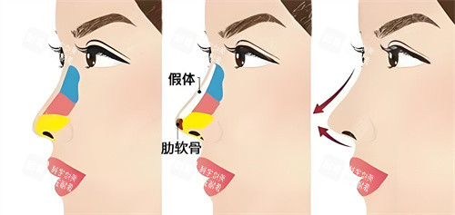 半肋骨隆鼻手術(shù)展示動畫圖 半肋骨隆鼻手術(shù)展示動畫圖