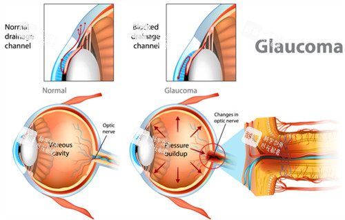 正常眼鏡和青光眼內(nèi)部區(qū)別