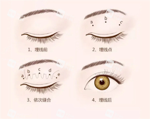 雙眼皮埋線過程圖 雙眼皮埋線過程圖